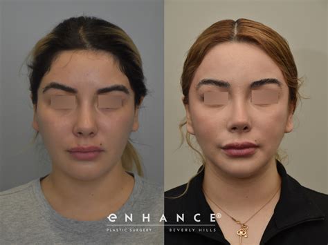 Image result for Cheekbones Reduction Book