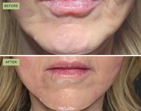 Image result for Cheek Threads