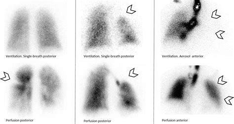 Ventilation-Perfusion Scan: A Primer for Practicing RadiologistsRadioGraphics