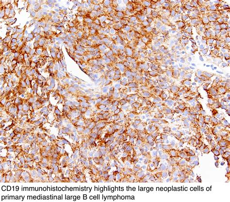 Pathology Outlines - Primary mediastinal large B cell lymphoma (PMBCL)