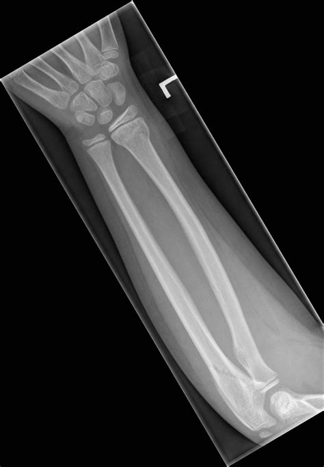 Distal Ulna Fracture X Ray at Alma Jones blog