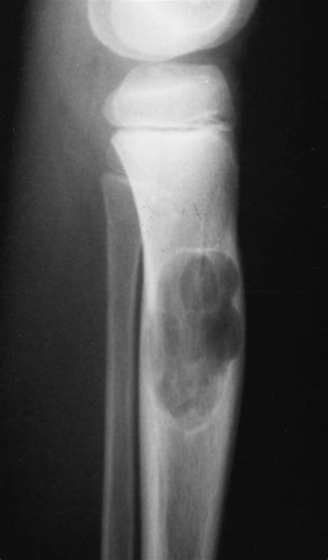 Osteosarcoma Radiology