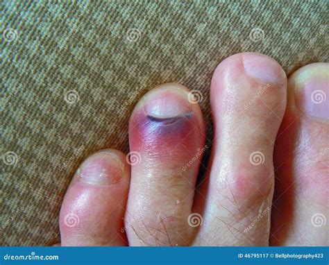 Bruised toe stock image. Image of feet, health, medical - 46795117