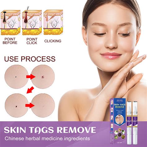 Buy Skin Wart Remover Salicylic Acid 17% Removedor de Verrugas Online at Lowest Price in India ...