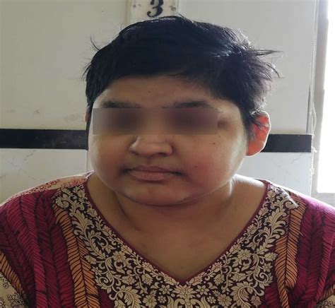 Laurence-Moon-Biedl syndrome, causes, symptoms, diagnosis, treatment & prognosis