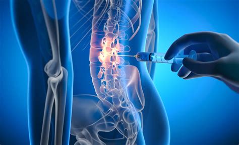 Facet Joint Injections For Back Pain Relief — PRECISION RADIOLOGY ...