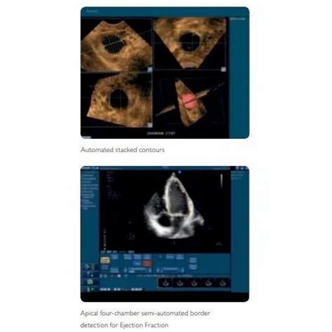 Philips Ultrasound Machine - Philips HD11XE Ultrasound Machine Trader ...