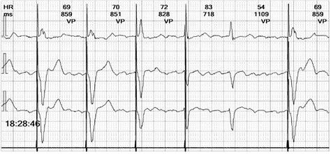 Wide Complex Irregular Rhythm in a Paced Patient: A Clinical Approach