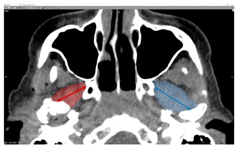 Pterygoid Plate Fracture