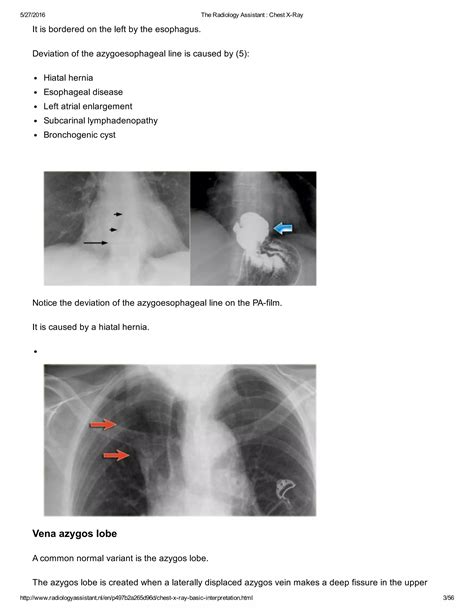 The radiology assistant chest x ray - basic interpretation | PDF