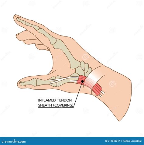 Thumb Tendon Pain