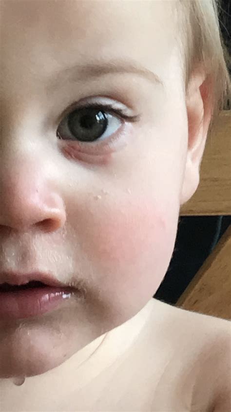 1 year old swollen/rash under eye
