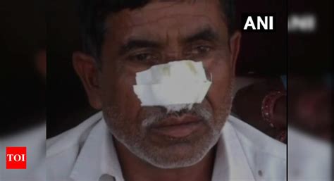 Uttar Pradesh: Man bites off brother's nose after denied money for ...