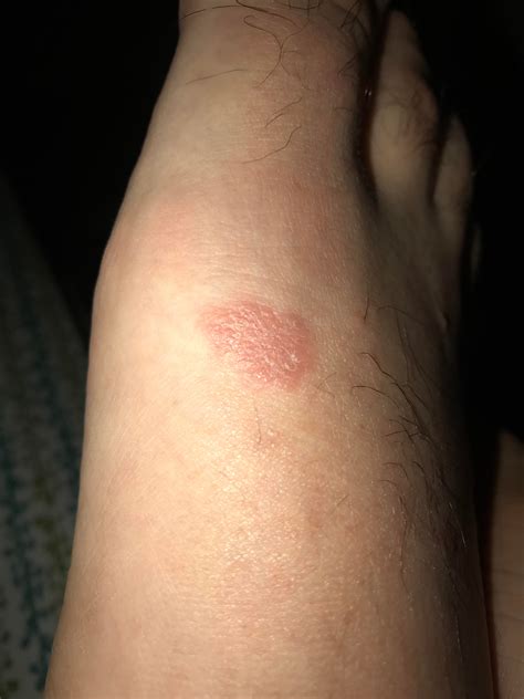 Started getting multiple red circular spots around my body, mostly ...