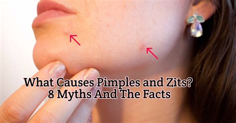 Image result for Exploding Face Zits