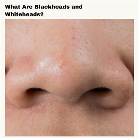Understanding the Differences: Blackheads vs. Whiteheads | Clinikally