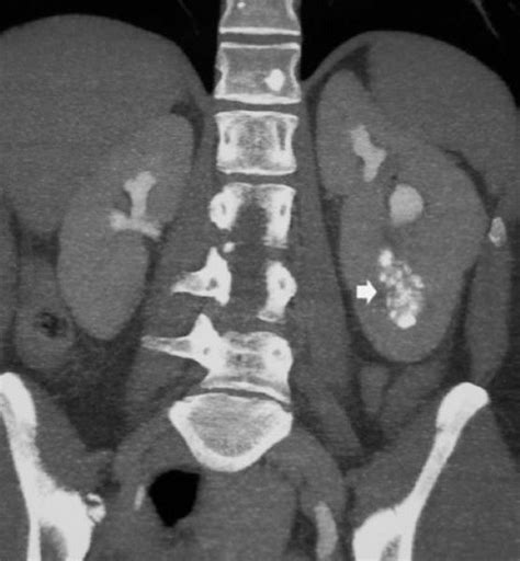 Medullary Sponge Kidney - Medullary Sponge Kidney - MSD Manual ...