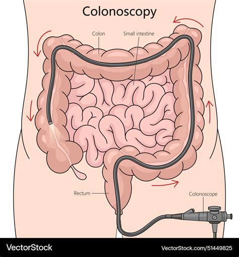 Image result for Position Colonoscopy Procedure