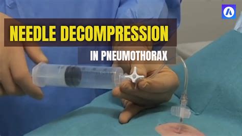 Image result for Locating Needle Decompression Site Using Open Hand as Guide