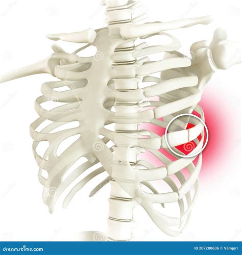Anatomy and Human Body. Costochondral Separation, Separated Rib. Broken, Fractured Ribs Stock ...