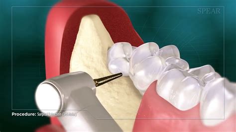 Surgical Extraction 12 的图像结果