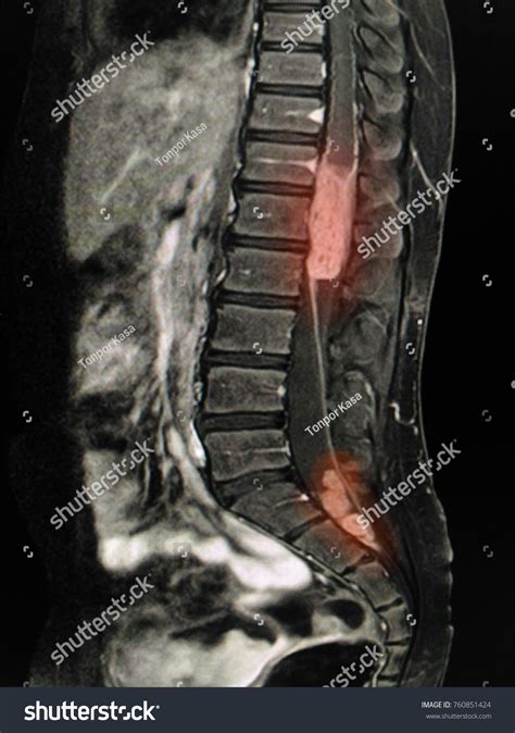 Lumbar Spine Mri Tumor
