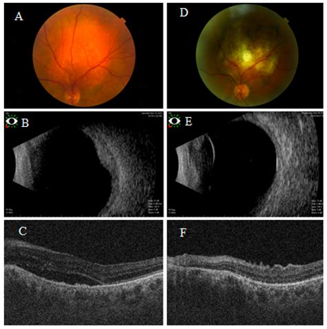 Laser Indirect Ophthalmoscopy-Guided Transpupillary Thermotherapy ...