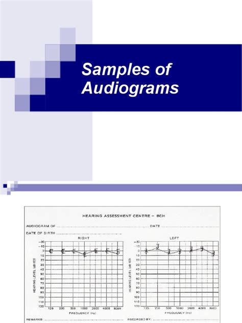 Audiogram Types and examples 的图像结果