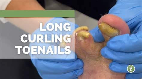 Curled Toenails Fix 的图像结果