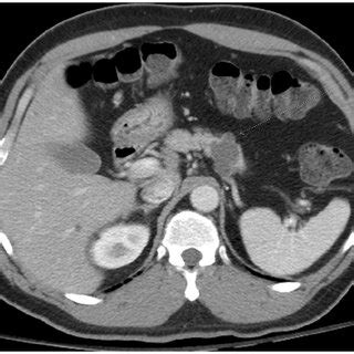 Image result for CT Scan with Contrast