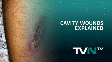 Image result for Devitalized Tissue Example