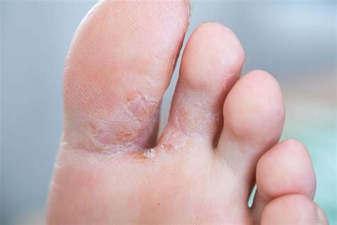12 Reasons Your Feet Are Itchy and How to Get Relief