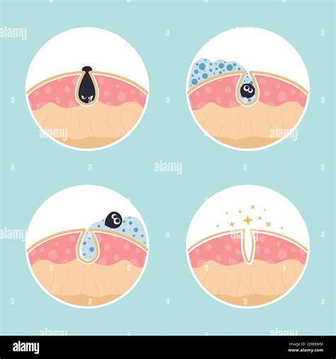 Blackhead skin hi-res stock photography and images - Alamy