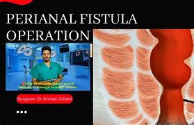 Image result for fistulectomy