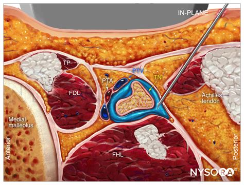 Genitofemoral Nerve Block Ultrasound