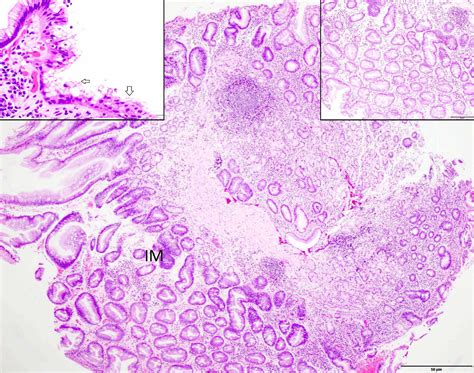 Pathology Outlines - Intestinal metaplasia