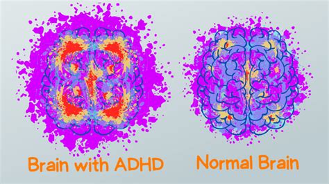 Image result for ADHD Brain Scan vs Normal