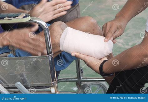 Elastic Bandaged Below Knee Amputation Stock Photo - Image of injury, doctor: 215077204