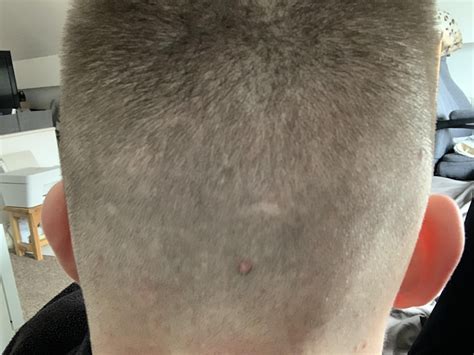 Skin coloured bump on scalp : r/DermatologyQuestions
