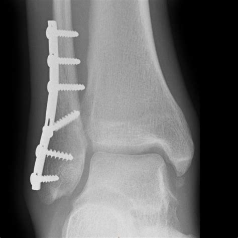 Weber B fracture and ORIF | Radiology Case | Radiopaedia.org