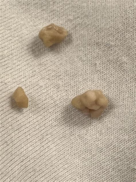 What is this? Not sure if it’s a stone as it’s soft. Feels like a popcorn kernel stuck in my ...