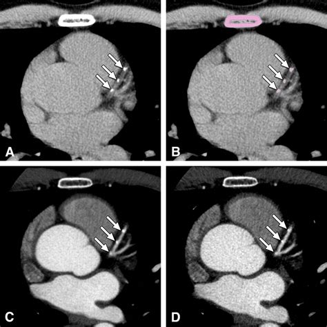 Assessment of Agatston Coronary Artery Calcium Score Using Contrast-Enhanced CT Coronary ...