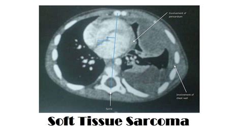 Image result for Soft Tissue Sarcoma