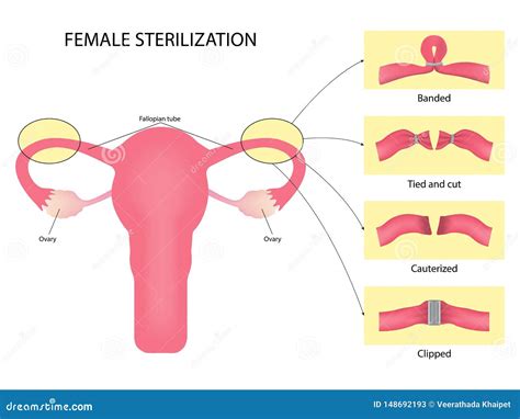 Tubal Ligation Diagram