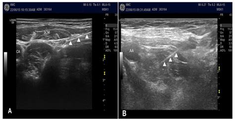 Combined Intermediate Cervical Plexus and Costoclavicular Block for ...
