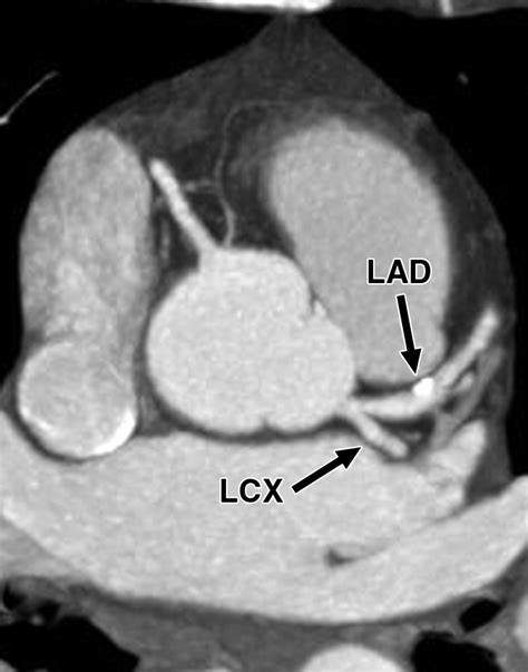 Cardiac Imaging: Part 2, Normal, Variant, and Anomalous Configurations of the Coronary ...