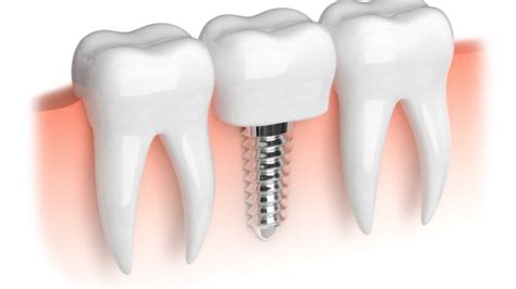 Dental Implant Cost In India 2025 - Doctors Finder