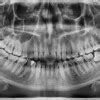 Impaksi Gigi - patofisiologi, diagnosis, penatalaksanaan - Alomedika
