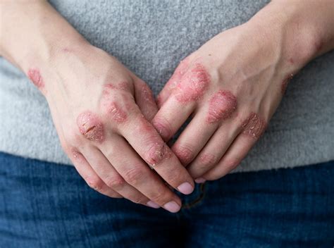 The Surprising Autoimmune Skin Disease-Gut Health Connection