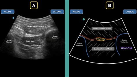 Sciatic Nerve Block
